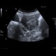 Fibroid of uterus, uterine fibroid: US - Ultrasound